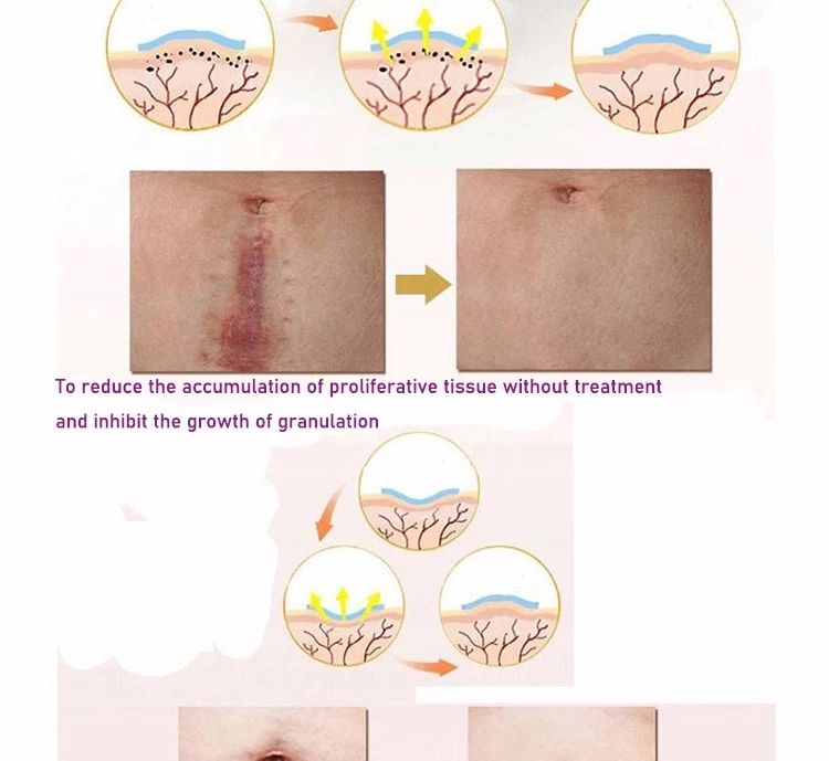 China 100% Effective C-section Silicone Gel Scar Removal Patch