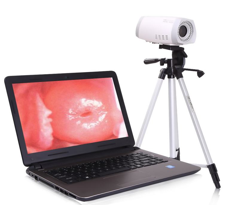 Portable digital Electronic Colposcope full hd sony camera for vagina colposcopy
